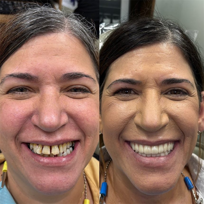 OneSolution® patient before and after dental implants
