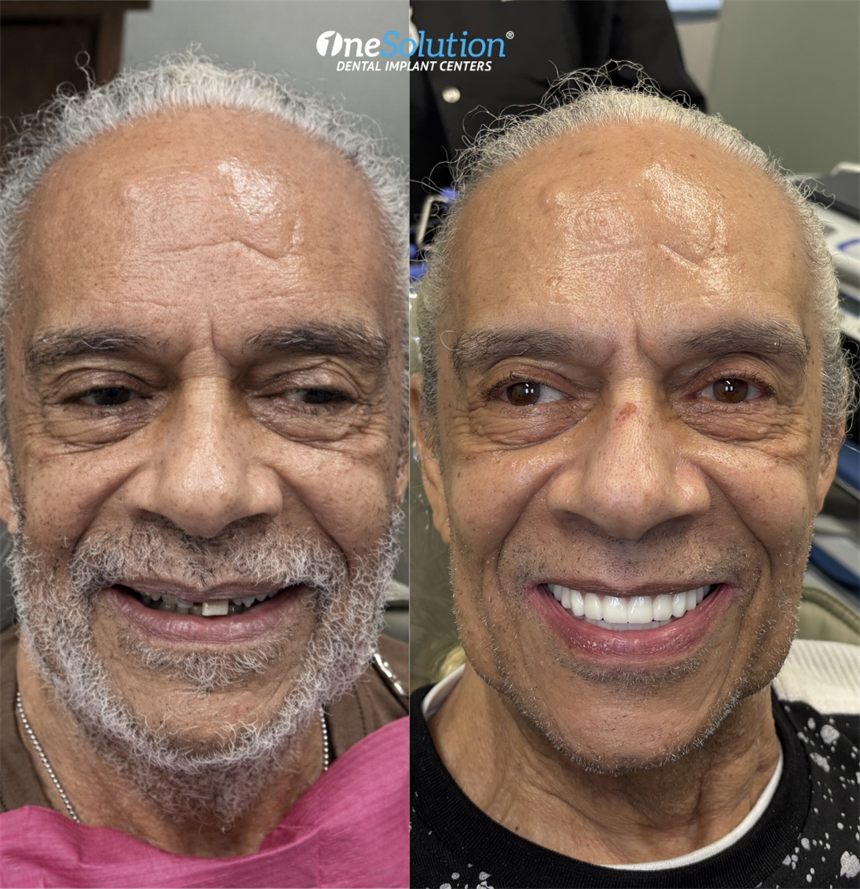 OneSolution® patient before and after dental implants