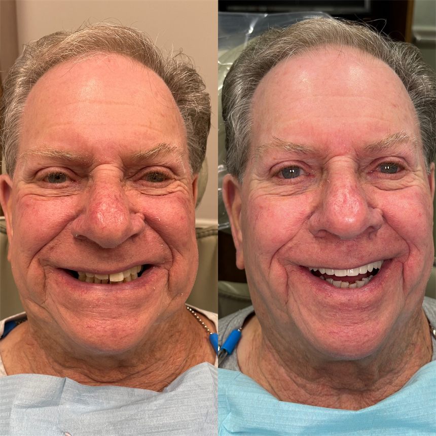 OneSolution® patient before and after dental implants
