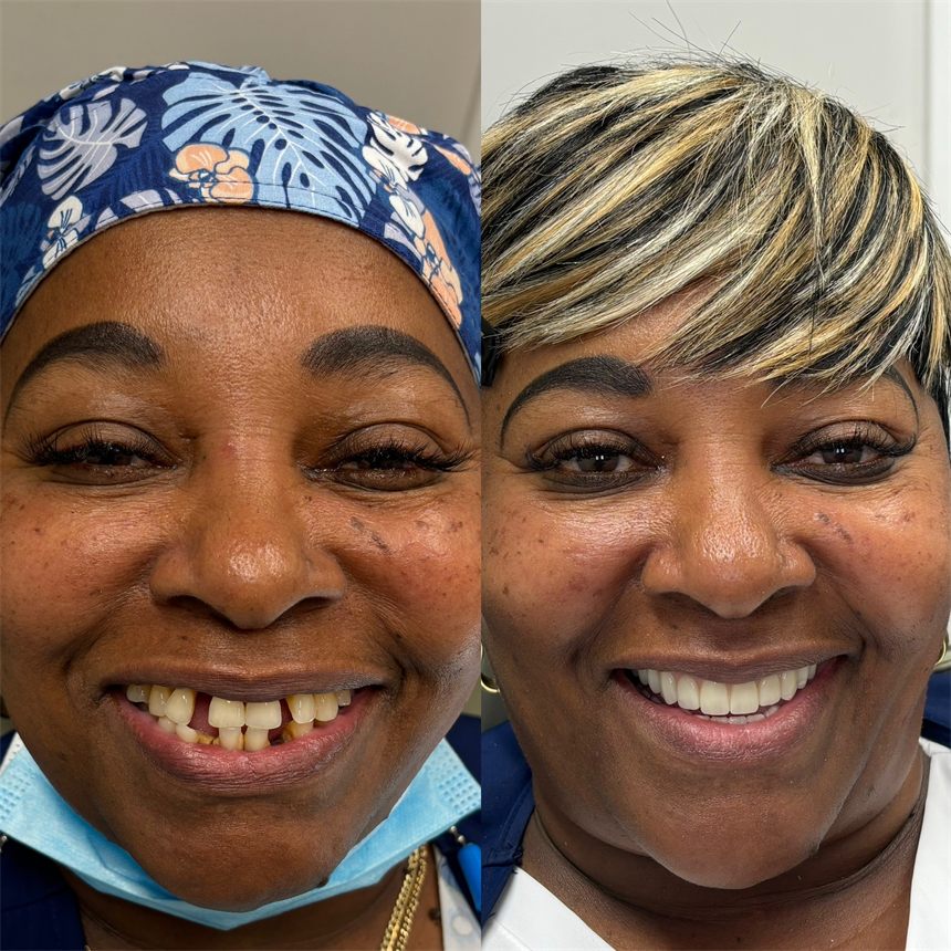 OneSolution® patient before and after dental implants