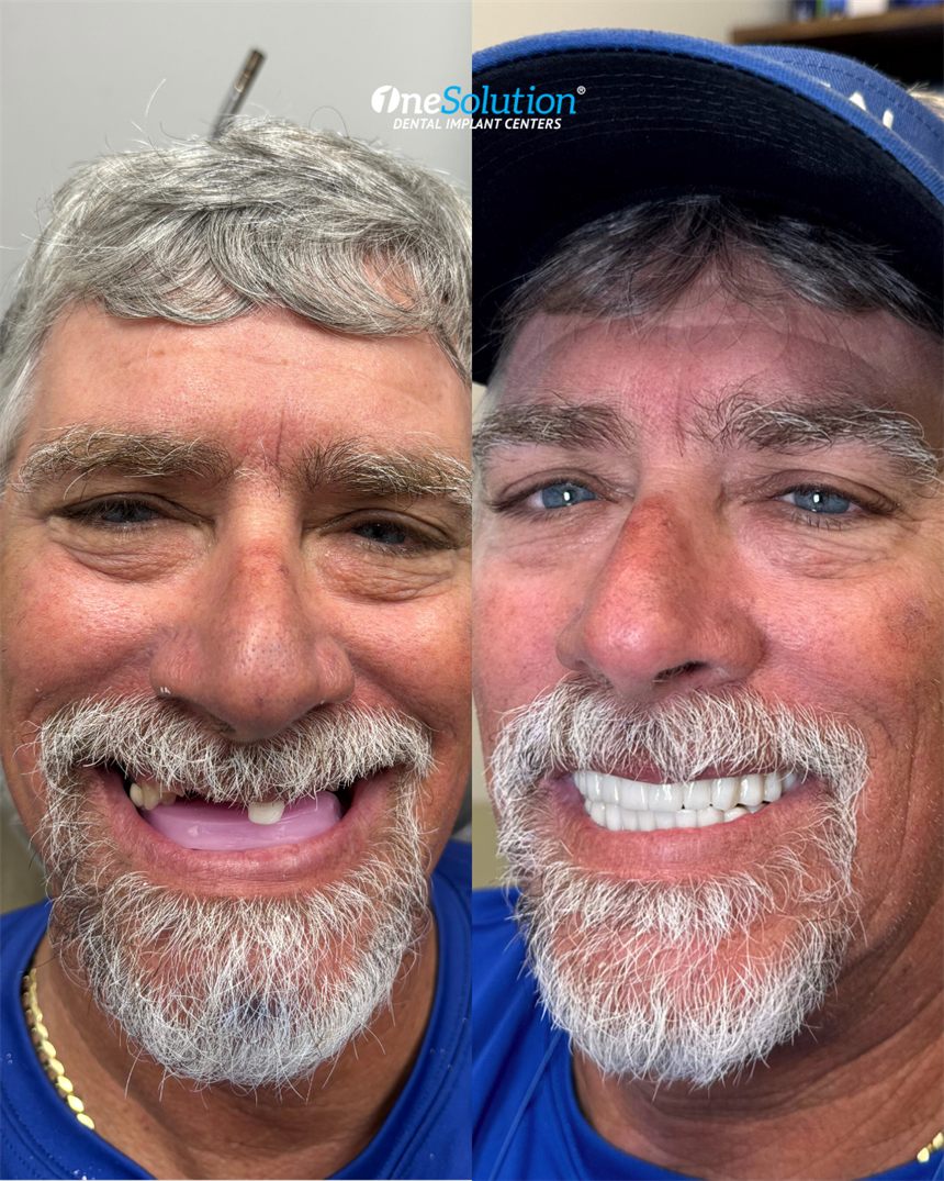 OneSolution® patient before and after dental implants