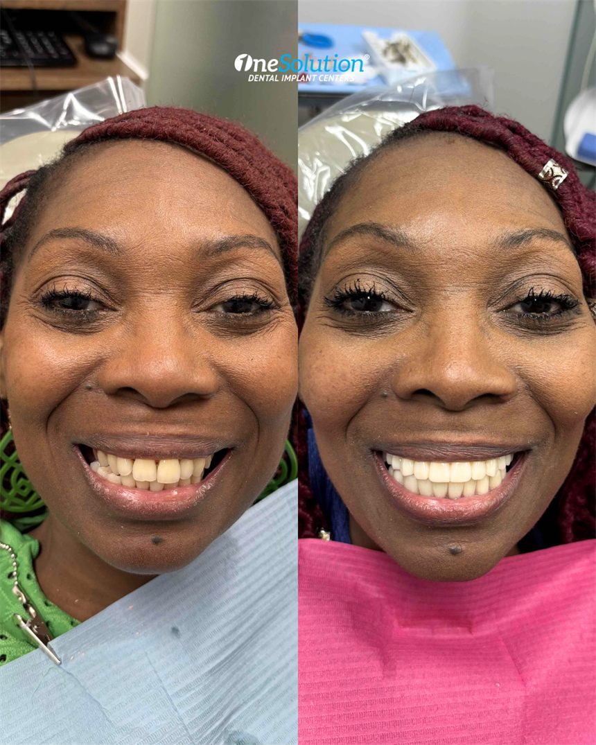 OneSolution® patient before and after dental implants