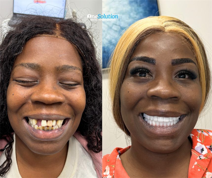 OneSolution® patient before and after dental implants