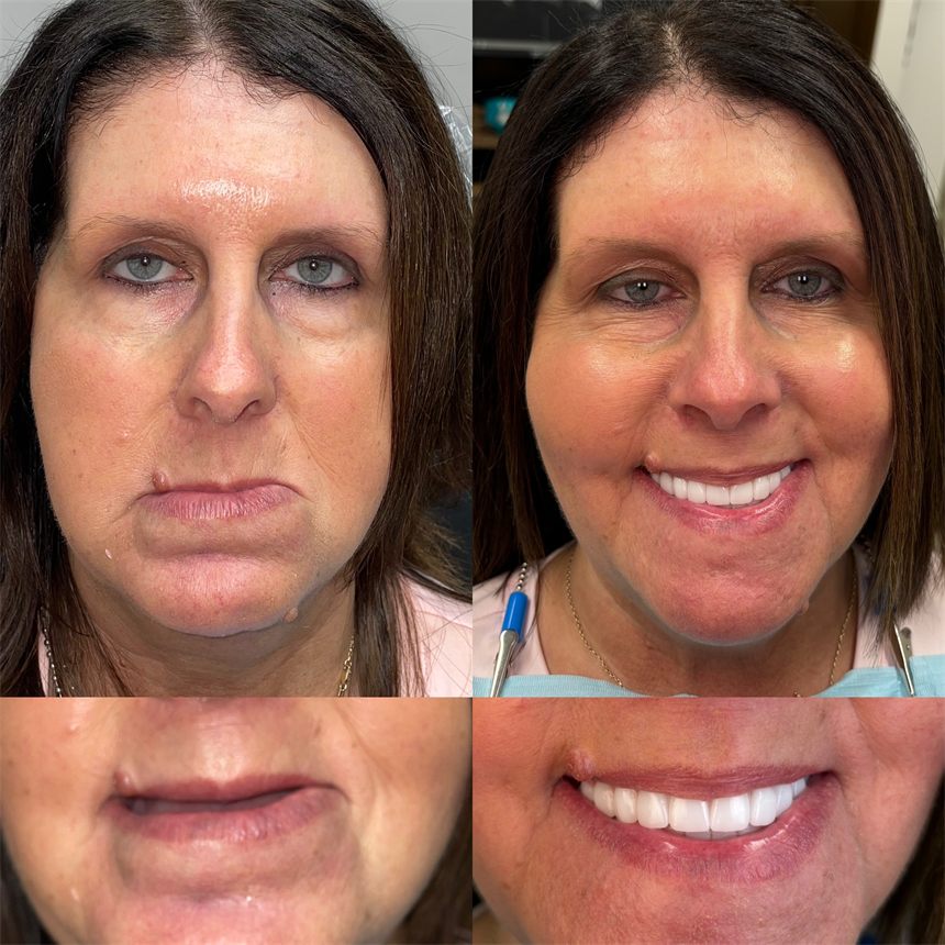 OneSolution® patient before and after dental implants