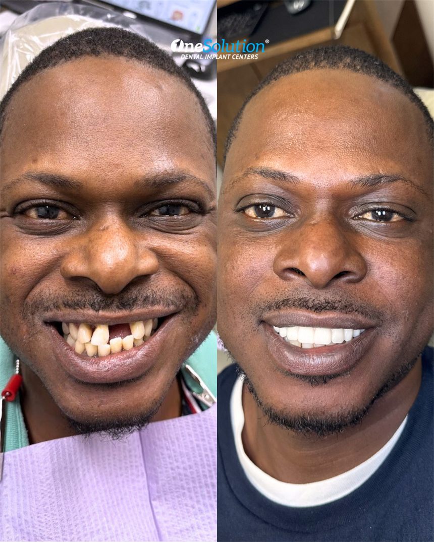 OneSolution® patient before and after dental implants