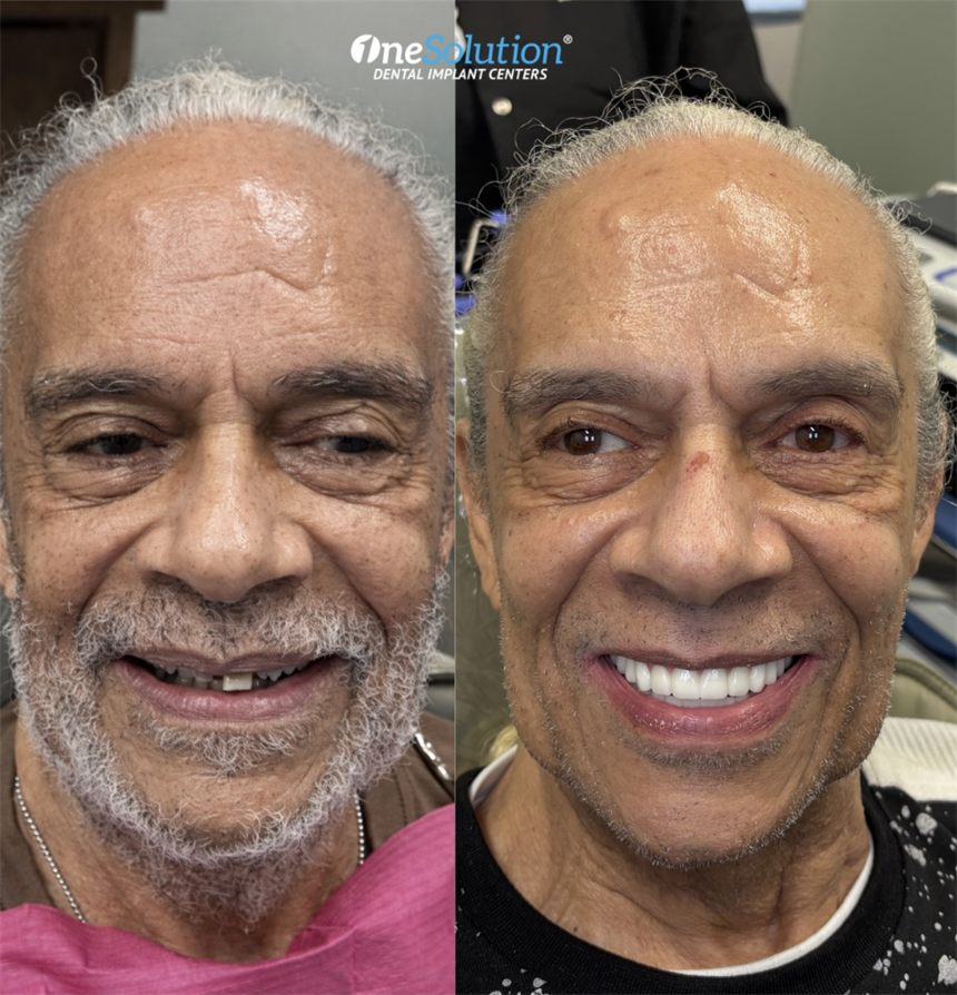OneSolution® patient before and after dental implants