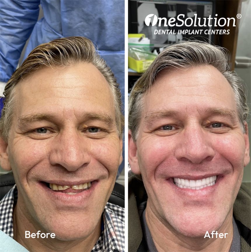 OneSolution® patient before and after dental implants