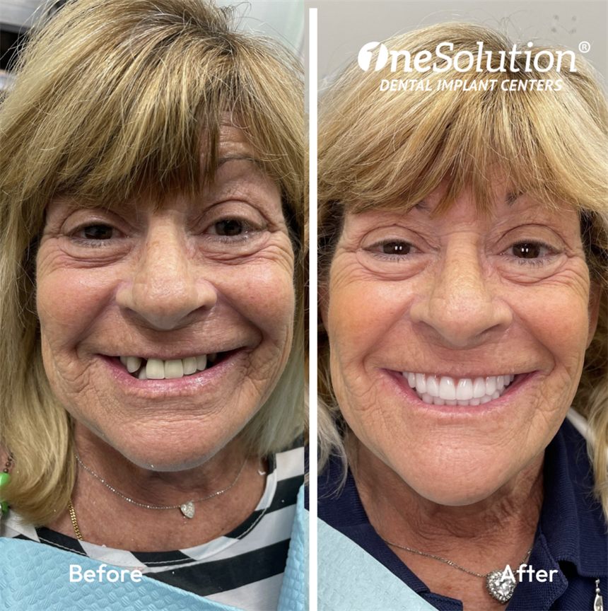 OneSolution® patient before and after dental implants