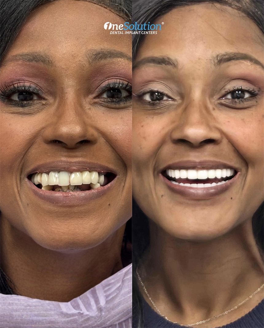 OneSolution® patient before and after dental implants