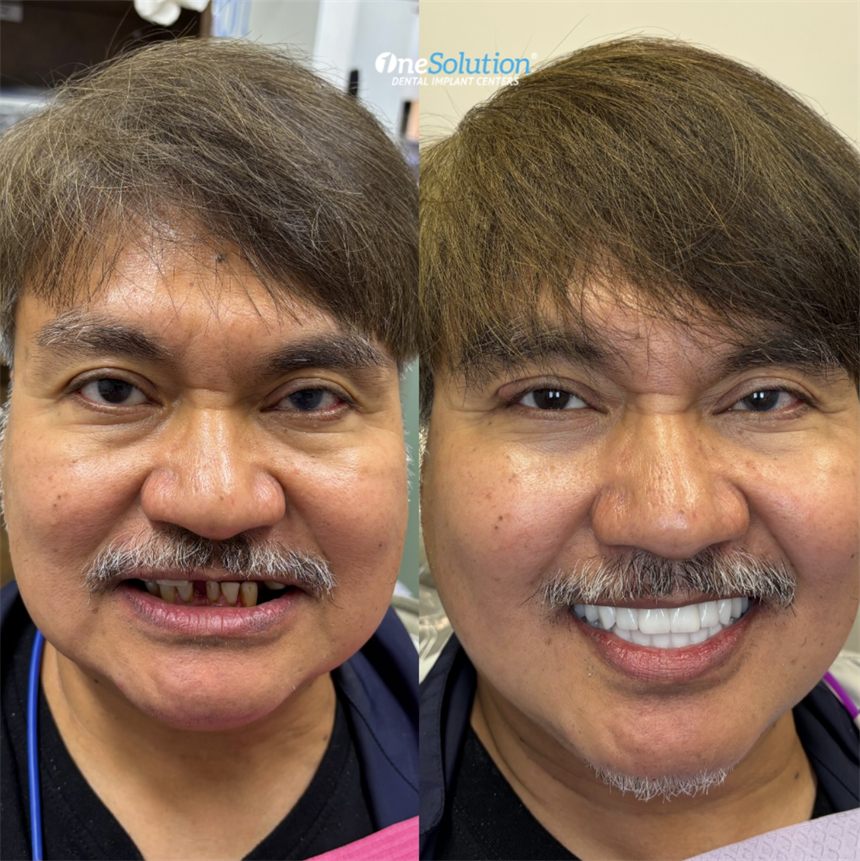 OneSolution® patient before and after dental implants